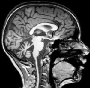 Cerebro